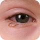 Conjunctivitis